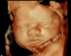 Pregnancy scan