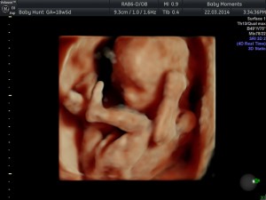 2D gender scan pregnancy scan