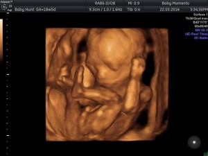 2D gender scan pregnancy scan