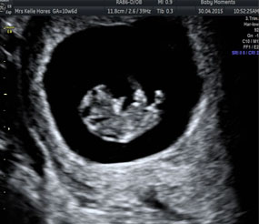 Can I have an early pregnancy scan?